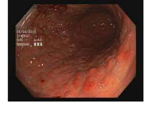 Case study on autoimmune gastristis...gokia