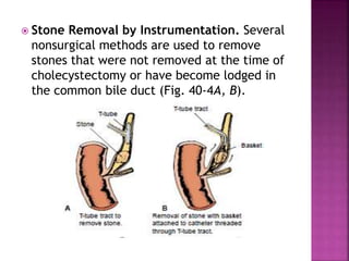  Stone Removal by Instrumentation. Several
nonsurgical methods are used to remove
stones that were not removed at the time of
cholecystectomy or have become lodged in
the common bile duct (Fig. 40-4A, B).
 