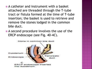  A catheter and instrument with a basket
attached are threaded through the T-tube
tract or fistula formed at the time of T-tube
insertion; the basket is used to retrieve and
remove the stones lodged in the common
bile duct.
 A second procedure involves the use of the
ERCP endoscope (see Fig. 40-4C).
 