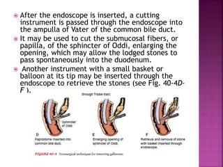  After the endoscope is inserted, a cutting
instrument is passed through the endoscope into
the ampulla of Vater of the common bile duct.
 It may be used to cut the submucosal fibers, or
papilla, of the sphincter of Oddi, enlarging the
opening, which may allow the lodged stones to
pass spontaneously into the duodenum.
 Another instrument with a small basket or
balloon at its tip may be inserted through the
endoscope to retrieve the stones (see Fig. 40-4D–
F ).
 