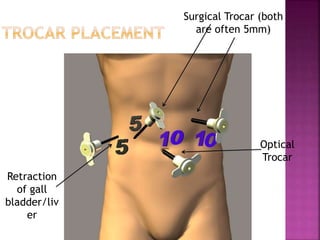Surgical Trocar (both
are often 5mm)
Optical
Trocar
Retraction
of gall
bladder/liv
er
 