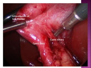 Cystic Duct
Cystic Artery
Infundibulum of
Gall Bladder
 