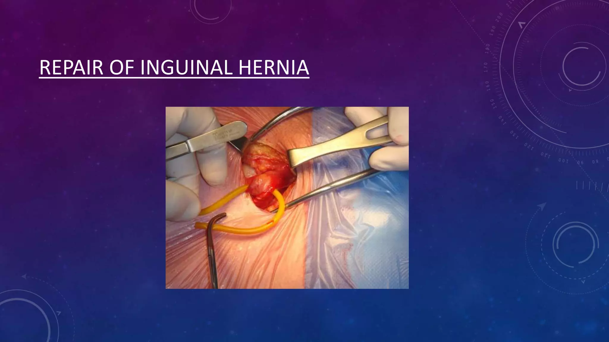 REPAIR OF INGUINAL HERNIA

 