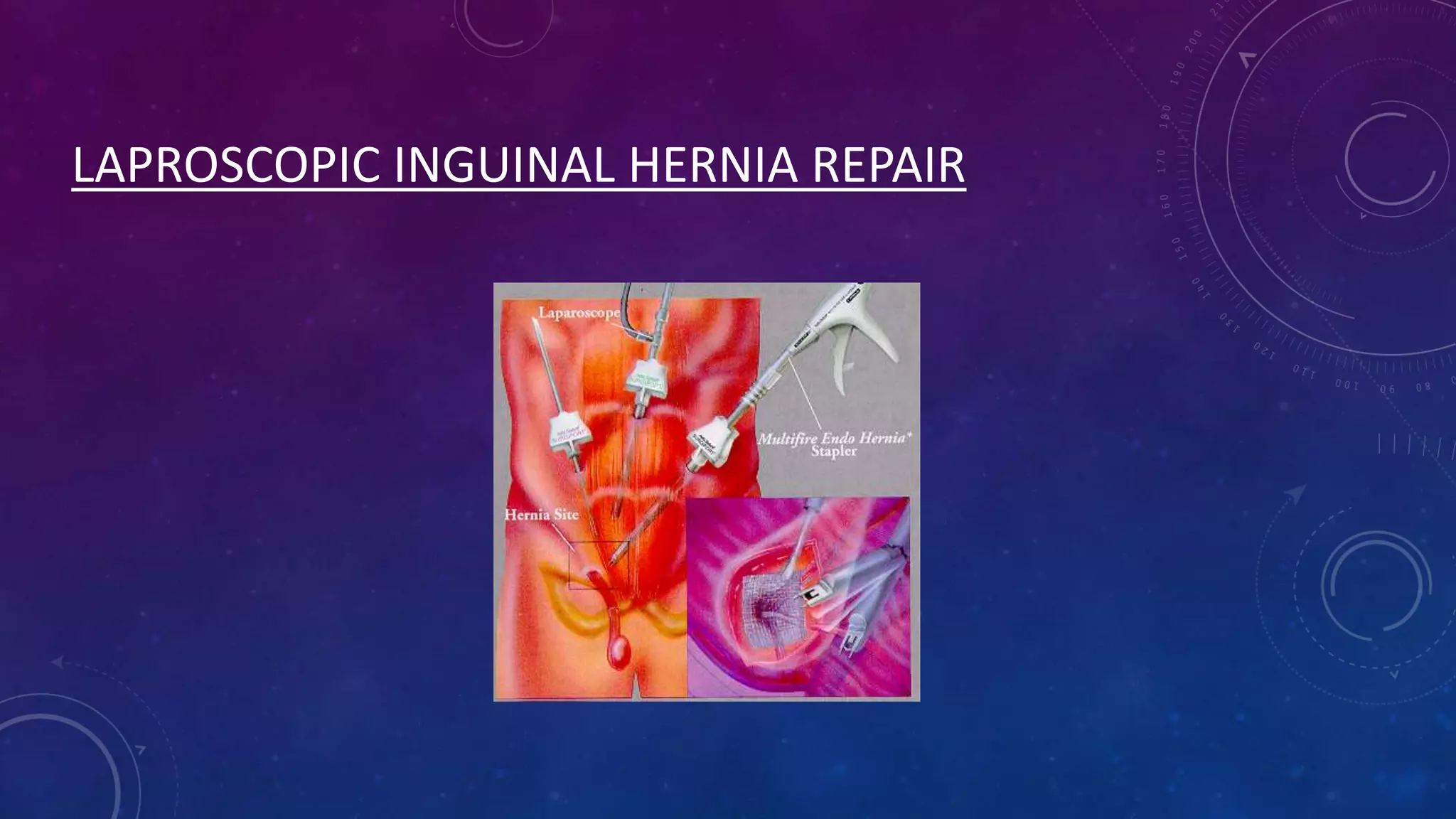 LAPROSCOPIC INGUINAL HERNIA REPAIR

 