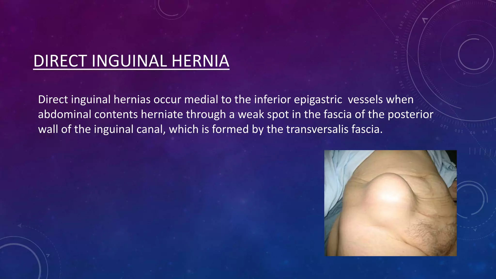 DIRECT INGUINAL HERNIA
Direct inguinal hernias occur medial to the inferior epigastric vessels when
abdominal contents herniate through a weak spot in the fascia of the posterior
wall of the inguinal canal, which is formed by the transversalis fascia.

 