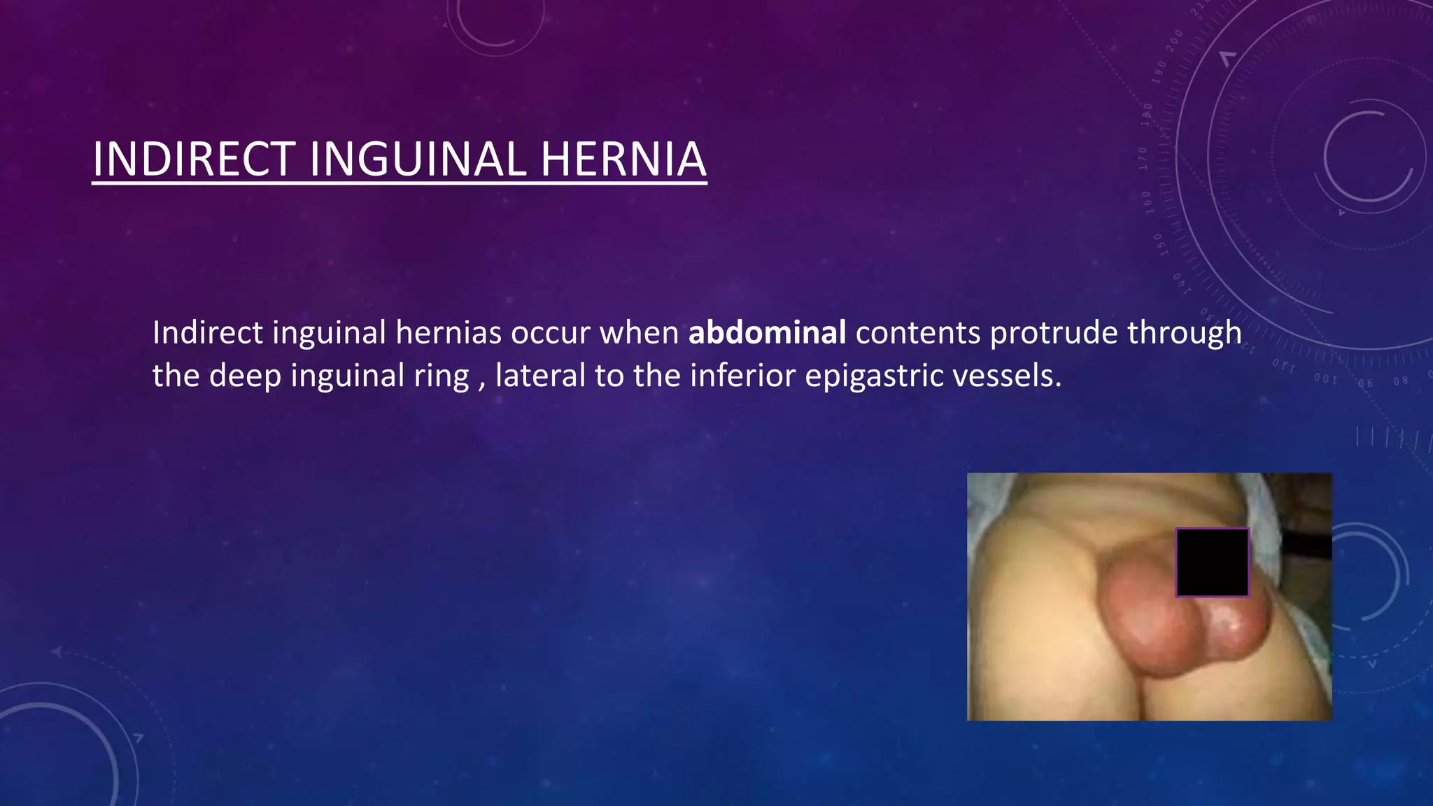 INDIRECT INGUINAL HERNIA
Indirect inguinal hernias occur when abdominal contents protrude through
the deep inguinal ring , lateral to the inferior epigastric vessels.

 