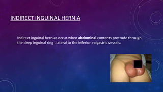 INDIRECT INGUINAL HERNIA
Indirect inguinal hernias occur when abdominal contents protrude through
the deep inguinal ring , lateral to the inferior epigastric vessels.

 