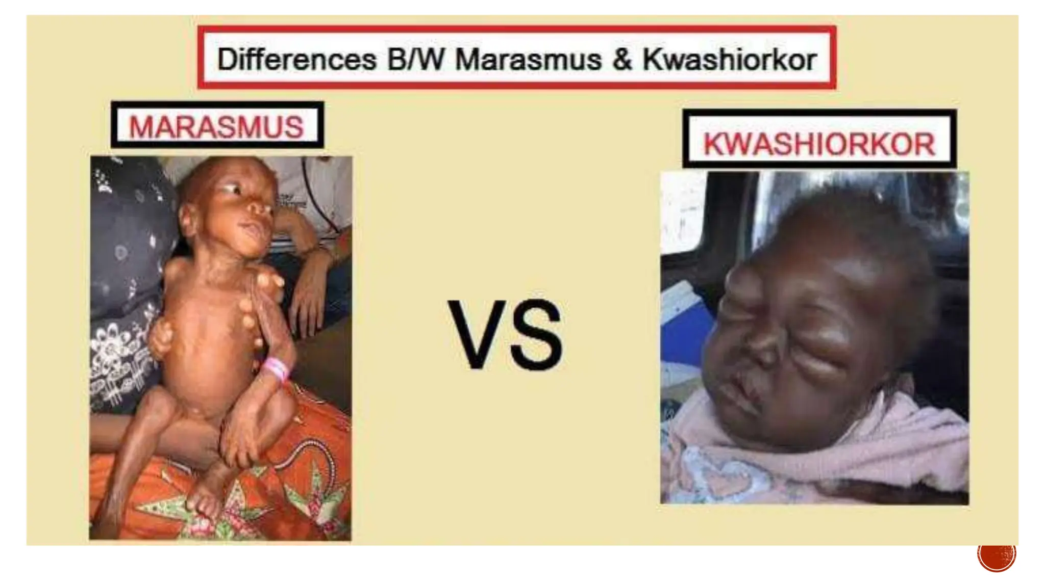 case-study-on-marasmus-and-kwashiorkor-pptx