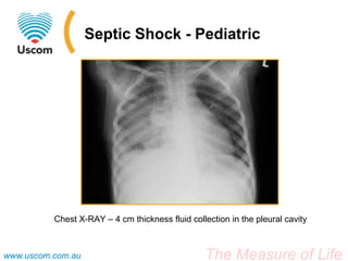 Septic Shock - Pediatric




          Chest X-RAY – 4 cm thickness fluid collection in the pleural cavity



www.uscom.com.au                                 The Measure of Life
 