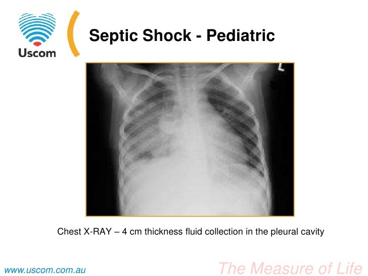 fever for paracetamol Case  Septic Study Shock Pediatric