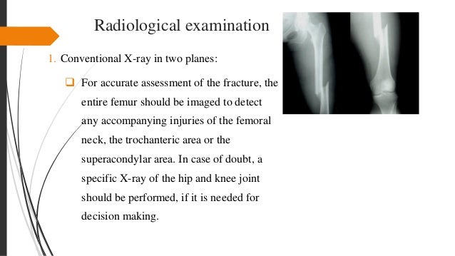 compound femur break