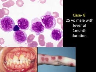 Case- 8
25 yo male with
fever of
1month
duration.
 