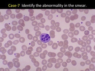 Case-7 Identify the abnormality in the smear.
 