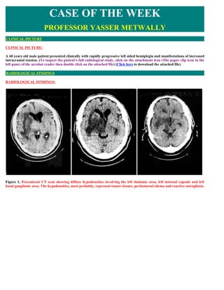 CASE OF THE WEEK
                        PROFESSOR YASSER METWALLY
CLINICAL PICTURE

CLINICAL PICTURE:

A 60 years old male patient presented clinically with rapidly progressive left sided hemiplegia and manifestations of increased
intracranial tension. (To inspect the patient's full radiological study, click on the attachment icon (The paper clip icon in the
left pane) of the acrobat reader then double click on the attached file) (Click here to download the attached file)

RADIOLOGICAL FINDINGS

RADIOLOGICAL FINDINGS:




Figure 1. Precontrast CT scan showing diffuse hypodensities involving the left thalamic area, left internal capsule and left
basal ganglionic area. The hypodensities, most probably, represent tumor tissues, peritumoral edema and reactive astrogliosis.
 