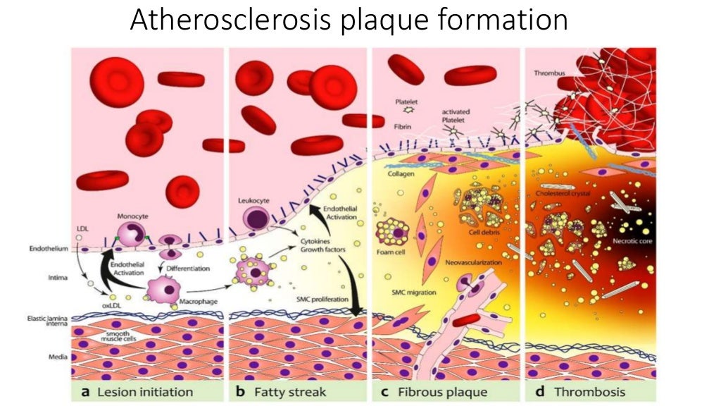 Case triple vessel disease