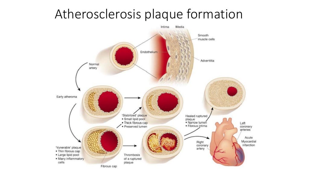 Case triple vessel disease
