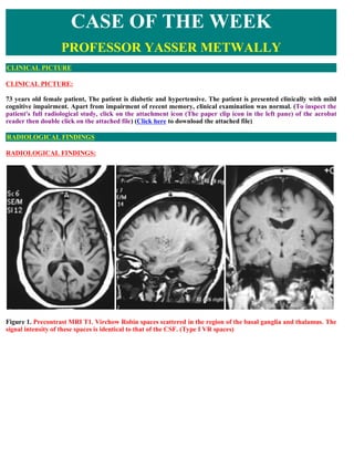 CASE OF THE WEEK
                   PROFESSOR YASSER METWALLY
CLINICAL PICTURE

CLINICAL PICTURE:

73 years old female patient, The patient is diabetic and hypertensive. The patient is presented clinically with mild
cognitive impairment. Apart from impairment of recent memory, clinical examination was normal. (To inspect the
patient's full radiological study, click on the attachment icon (The paper clip icon in the left pane) of the acrobat
reader then double click on the attached file) (Click here to download the attached file)

RADIOLOGICAL FINDINGS

RADIOLOGICAL FINDINGS:




Figure 1. Precontrast MRI T1. Virchow Robin spaces scattered in the region of the basal ganglia and thalamus. The
signal intensity of these spaces is identical to that of the CSF. (Type I VR spaces)
 