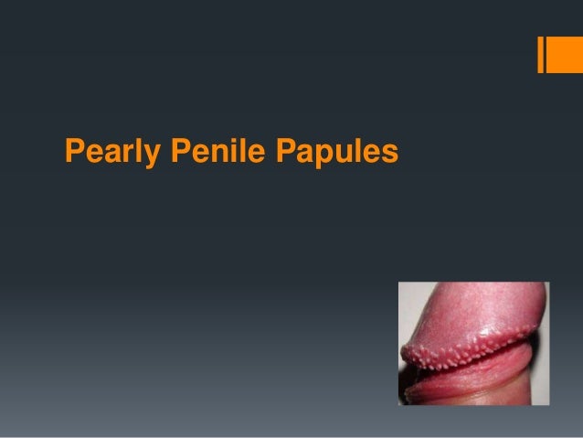 Vs penile herpes papules Pearly Penile