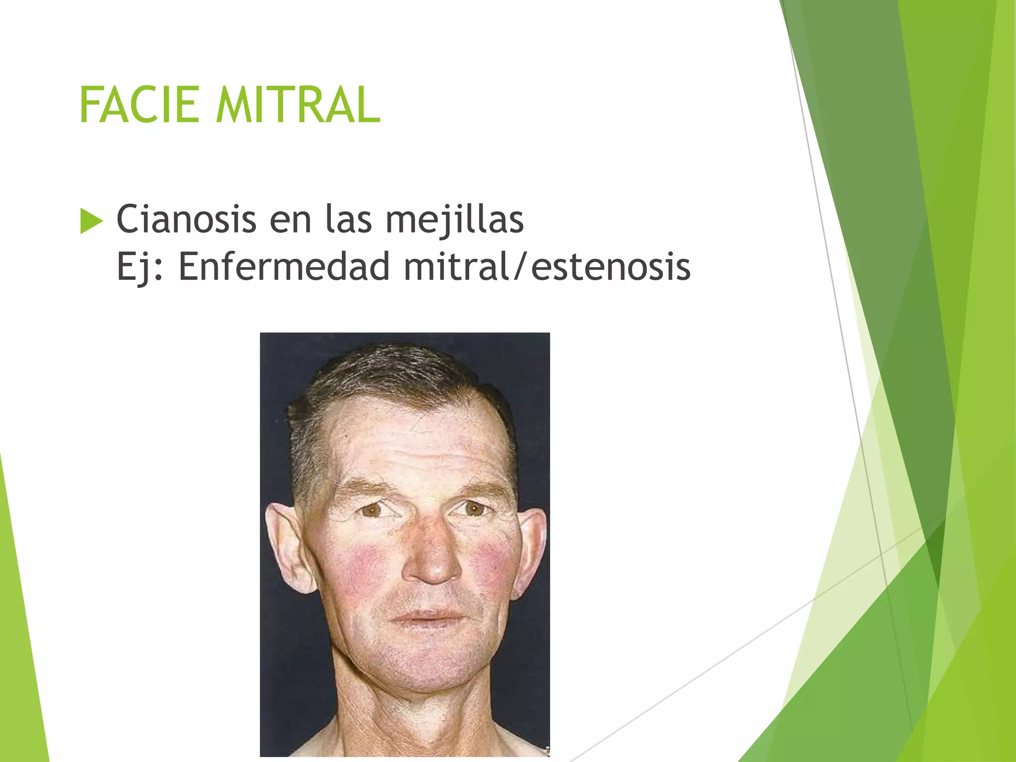 Semiologia Médica - Facies | PPTX