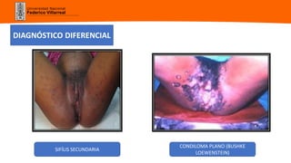 Universidad Nacional
Federico Villarreal
DIAGNÓSTICO DIFERENCIAL
SIFÍLIS SECUNDARIA
CONDILOMA PLANO (BUSHKE
LOEWENSTEIN)
 