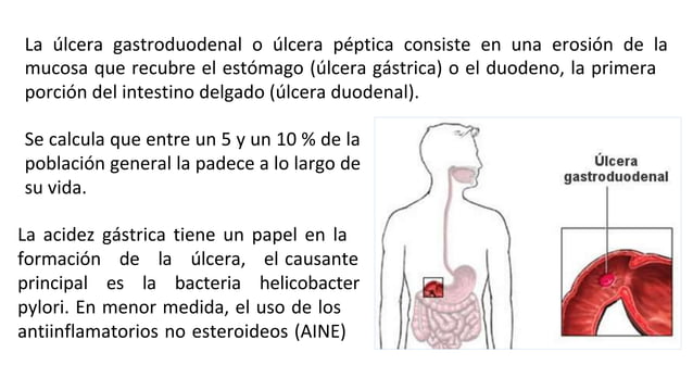 Caso Clinico De Ulcera Gastrica Por Helicobacter Pylori