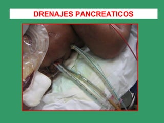 DRENAJES PANCREATICOS
 