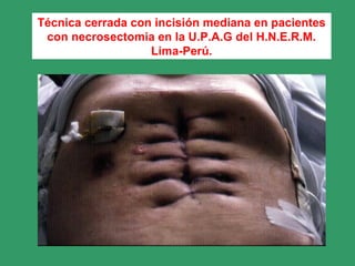 Técnica cerrada con incisión mediana en pacientes
con necrosectomia en la U.P.A.G del H.N.E.R.M.
Lima-Perú.
 