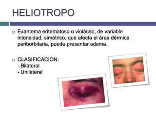 HELIOTROPO
 Exantema eritematoso o violáceo, de variable
intensidad, simétrico, que afecta el área dérmica
periborbitaria, puede presentar edema.
 CLASIFICACION:
- Bilateral
- Unilateral
 