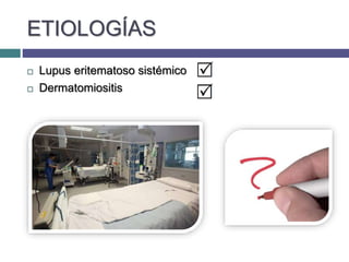 ETIOLOGÍAS
 Lupus eritematoso sistémico
 Dermatomiositis
 