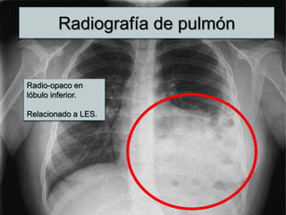 Radiografía de pulmón
Radio-opaco en
lóbulo inferior.
Relacionado a LES.
 