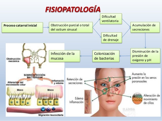 Sinusitis Causas Sntomas Prevencin Y Tratamiento