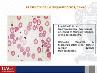 • Esquistocitosis - o
Fragmentocitosis – fragmentos
de células en forma de triangulo,
yelmo, casco, lagrima.
• Hemolisis mecánica, A.
Microangiopatica o por prótesis
valvular, purpura
trombocitopenia.
PRESENCIA DE 1-2 ESQUISTOCITOS/CAMPO
 