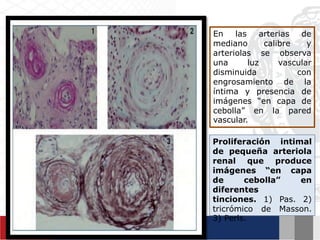 En las arterias de
mediano calibre y
arteriolas se observa
una luz vascular
disminuida con
engrosamiento de la
íntima y presencia de
imágenes “en capa de
cebolla” en la pared
vascular.
Proliferación intimal
de pequeña arteriola
renal que produce
imágenes “en capa
de cebolla” en
diferentes
tinciones. 1) Pas. 2)
tricrómico de Masson.
3) Perls.
 