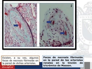 Existen, a su vez, algunos
focos de necrosis fibrinoide en
la pared de dichas arteriolas.
Focos de necrosis fibrinoide
en la pared de las arteriolas
renales en la tinción de
tricrómico de Masson.
 