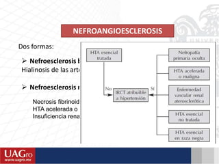 NEFROANGIOESCLEROSIS
 Nefroesclerosis benigna
Hialinosis de las arteriolas aferentes
 Nefroesclerosis maligna
Dos formas:
Necrosis fibrinoide en las arteriolas
HTA acelerada o maligna
Insuficiencia renal6
 