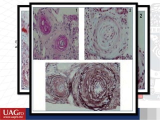 Clínica
• PS >12mmHg
• Papiledema
• Hemorragias retinianas
• Encefalopatía
• Anormalidades cardiovascualares e
insuficiencia cardiaca
Necrosis fibrinoide de las arteriolas
Infiltrado inflamatorio, glomérulos necróticos infiltrado neutrofilicos y
capilares glomerulares trombosados.
Capas de cebolla
Engrosamiento de la intima, por proliferación d elas células del musculo liso
alargadas y dispuestas concéntricamente junto a las capas finas de colageno
 