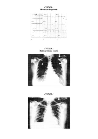 FIGURA 1
Electrocardiograma:




     FIGURA 2
Radiografía de tórax:




     FIGURA 3
 