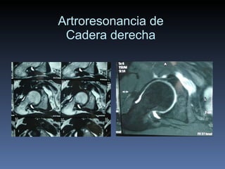 Artroresonancia de  Cadera derecha  