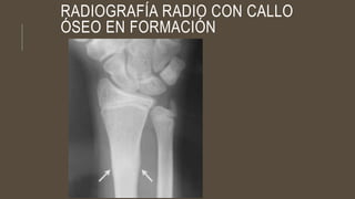 RADIOGRAFÍA RADIO CON CALLO
ÓSEO EN FORMACIÓN
 