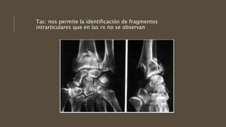 Tac: nos permite la identificación de fragmentos
intrarticulares que en las rx no se observan
 
