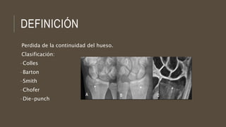 DEFINICIÓN
Perdida de la continuidad del hueso.
Clasificación:
-Colles
-Barton
-Smith
-Chofer
-Die-punch
 