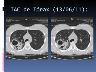 TAC de Tórax (13/06/11): 