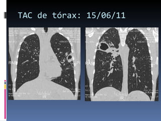 TAC de tórax: 15/06/11 