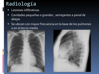 Radiología Lesiones infiltrativas Cavidades pequeñas o grandes , semejantes a panal de abejas Se ubican con mayor frecuencia en la base de los pulmones o en el tercio medio 