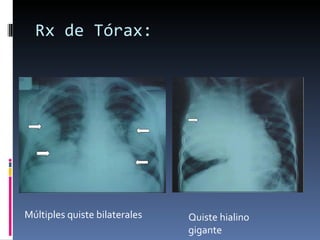 Rx de Tórax: Quiste hialino gigante Múltiples quiste bilaterales 