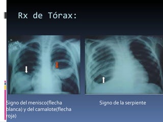 Rx de Tórax: Signo del menisco(flecha blanca) y del camalote(flecha roja) Signo de la serpiente 
