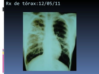 Rx de tórax:12/05/11 