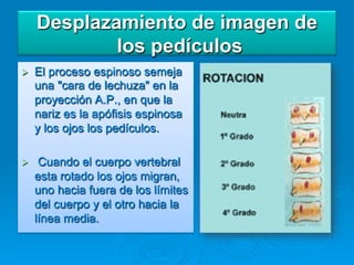 Desplazamiento de imagen de
              los pedículos
Ø    El proceso espinoso semeja
      una "cara de lechuza" en la
      proyección A.P., en que la
      nariz es la apófisis espinosa
      y los ojos los pedículos.

Ø     Cuando el cuerpo vertebral
      esta rotado los ojos migran,
      uno hacia fuera de los límites
      del cuerpo y el otro hacia la
      línea media.
 