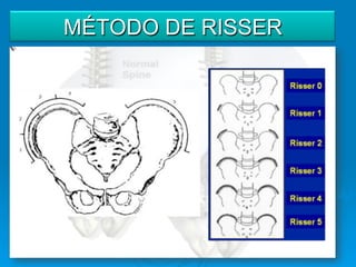 MÉTODO DE RISSER
 