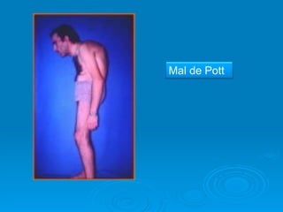 Mal de Pott
 